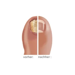 Medonail Nagelpflege bei Pilzbefall Medosan